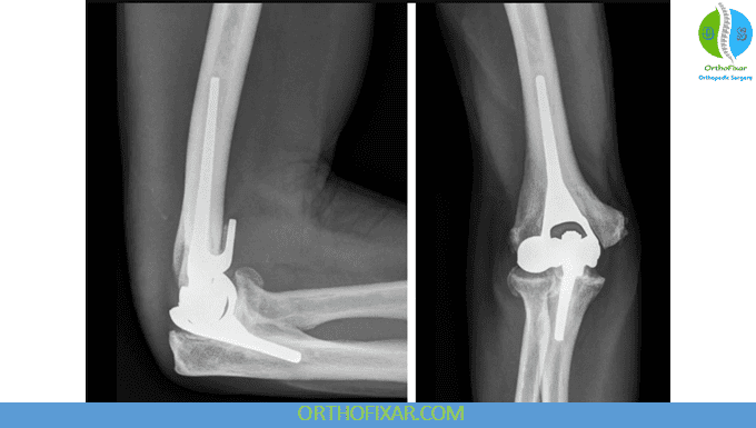Elbow Replacement xray