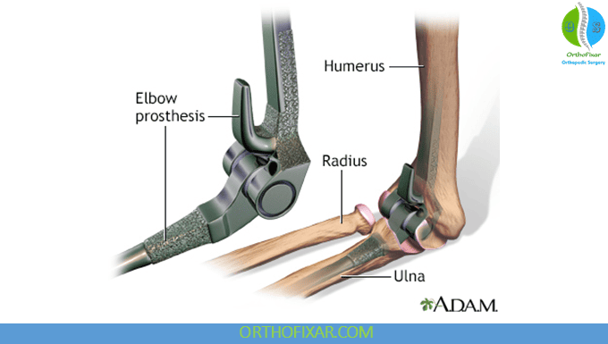 Elbow Replacement
