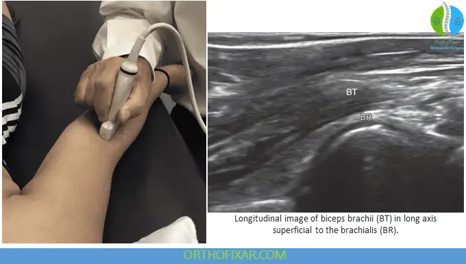 Elbow Ultrasound - Longitudinal view of anterior elbow