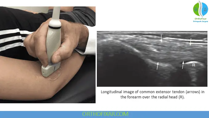 Elbow US - Longitudinal view of common extensor tendon