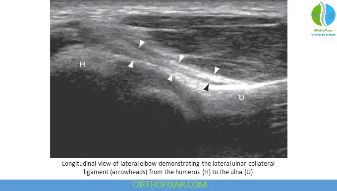 elbow ultrasonography - Longitudinal view of lateral elbow demonstrating the lateral ulnar collateral ligament