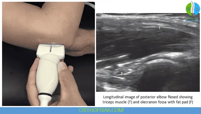 Elbow Ultrasound - Longitudinal view of posterior elbow