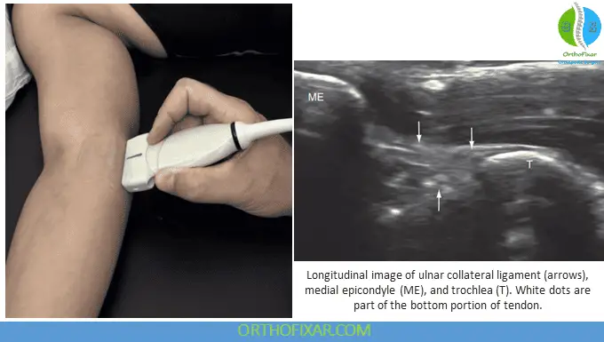 Elbow Ultrasound - Longitudinal view of ulnar collateral ligament