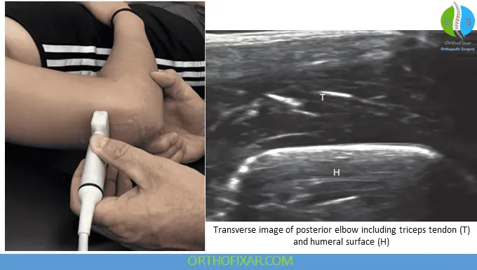 Elbow Ultrasound - Transverse view of posterior elbow joint