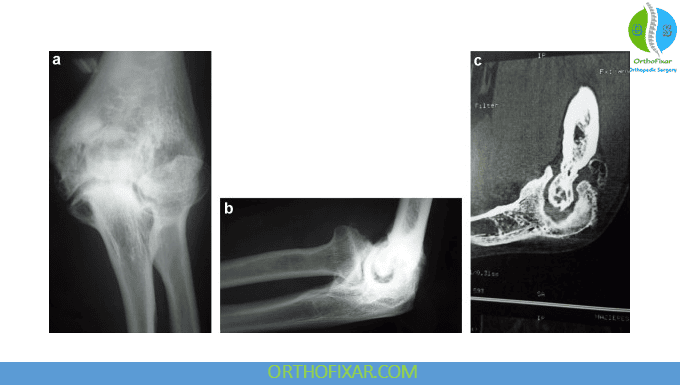 Elbow osteoarthritis