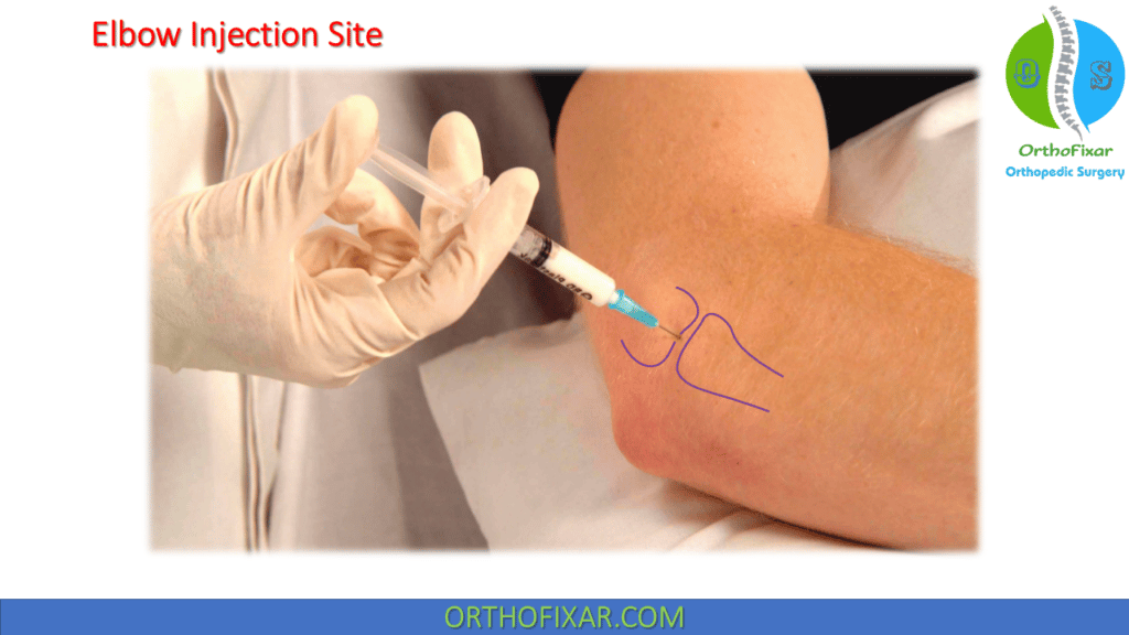 Elbow steroid Injection
