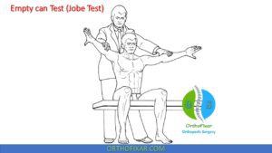 Empty Can Test For Supraspinatus Impingement - OrthoFixar 2026