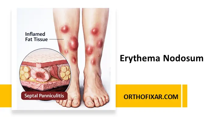 Erythema Nodosum En