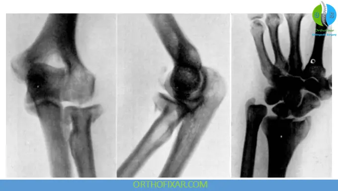 Essex-Lopresti Lesion