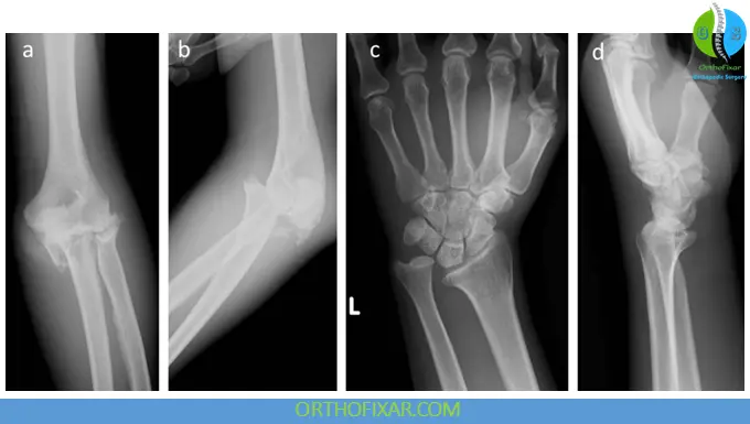 Essex-Lopresti injury xray