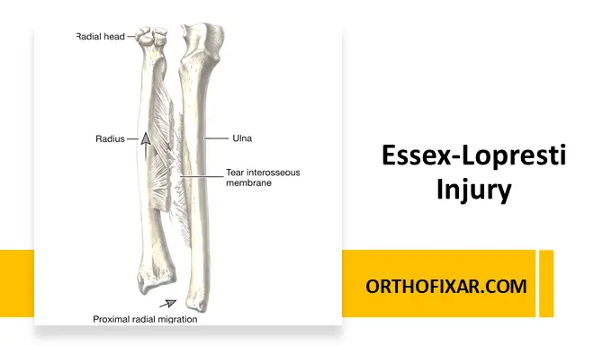 Essex-Lopresti injury