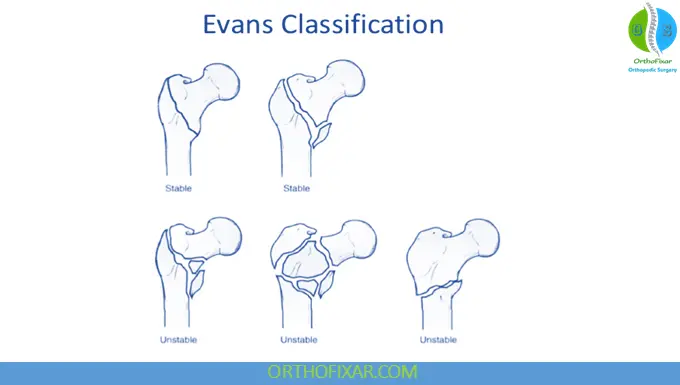Evans Classification