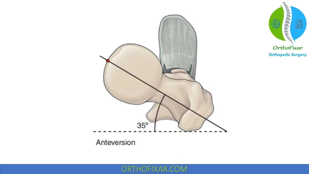 Excessive femoral anteversion