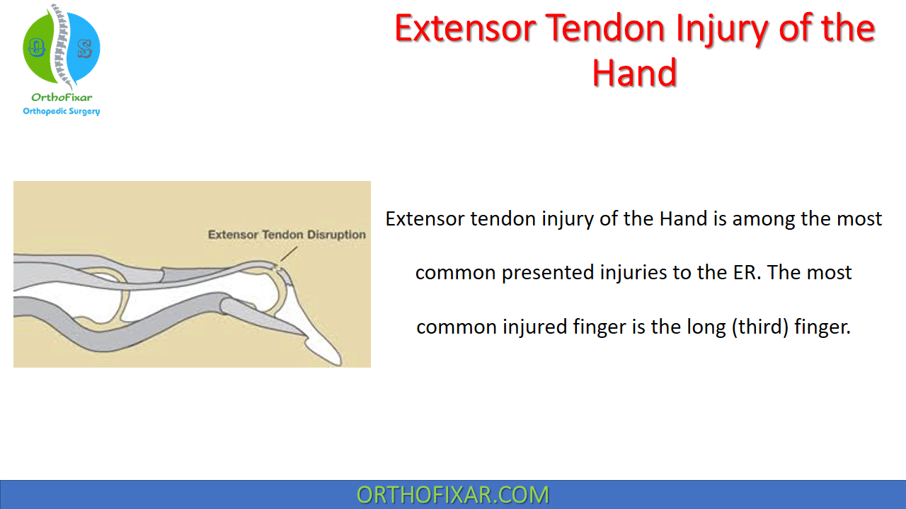 Extensor Tendon Injury of the Hand