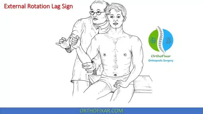 External rotation lag sign (1)