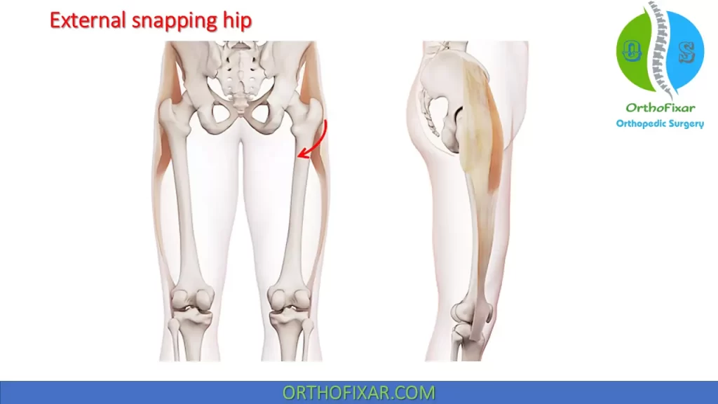 External snapping hip