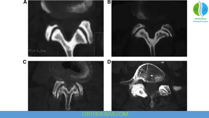 Facet Arthropathy Grading