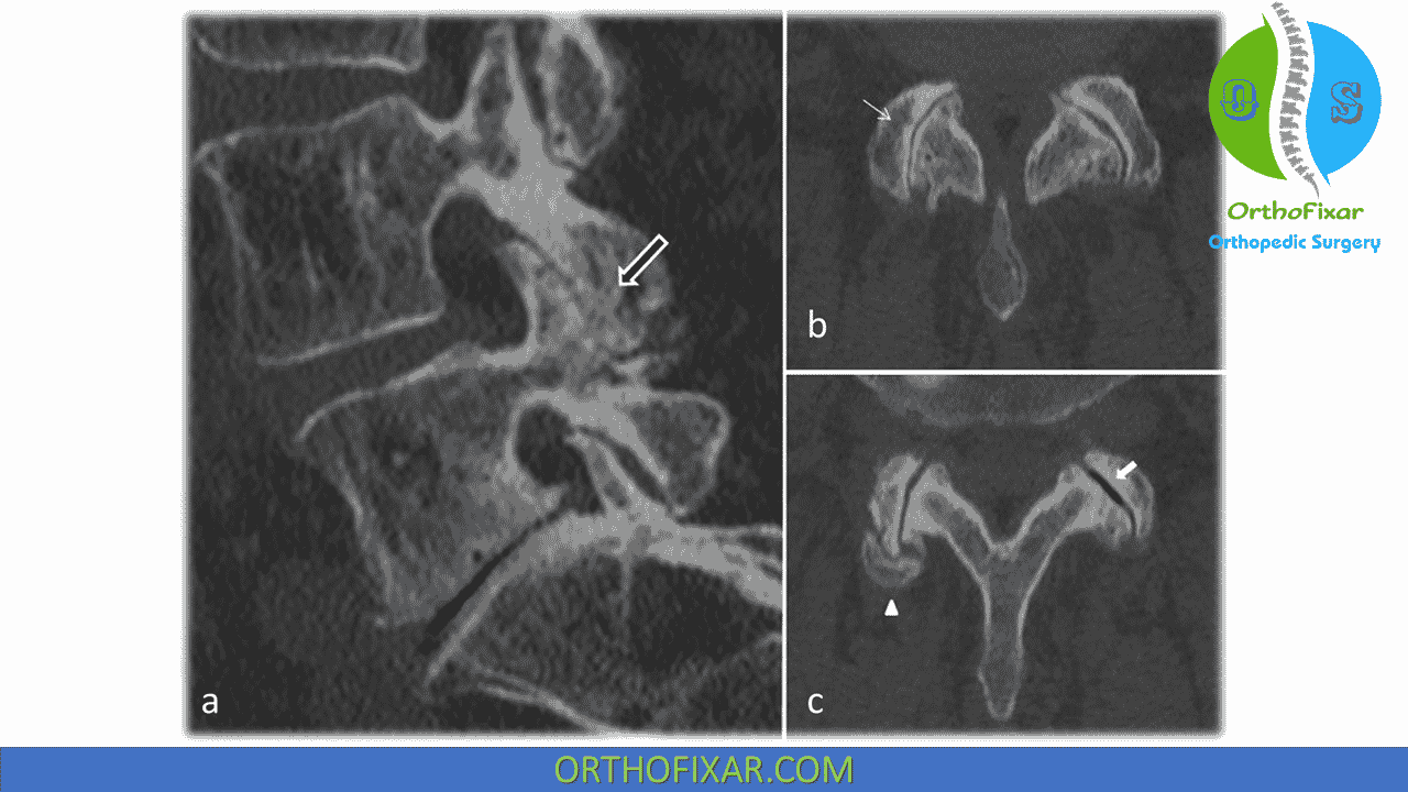 Facet Joint Dysfunction OrthoFixar 2024