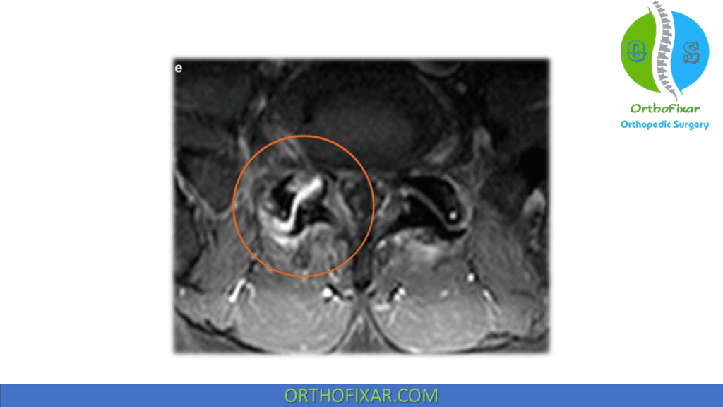 Facet Joint Dysfunction MRI