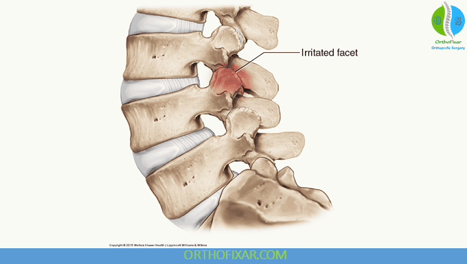 Facet Joint Syndrome