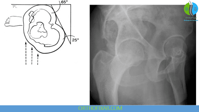 Hip Joint X-Ray Imaging 6 False-Profile Hip X-Ray