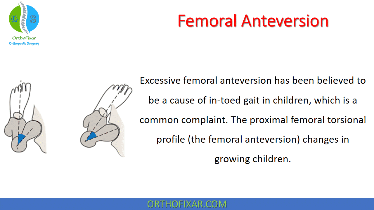  Femoral Anteversion 