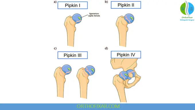 Femoral Head Fracture - Pipkin Classification