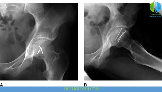 Femoral Head Fracture treatment with screws