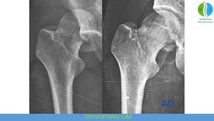 Femoral Head Fracture xray