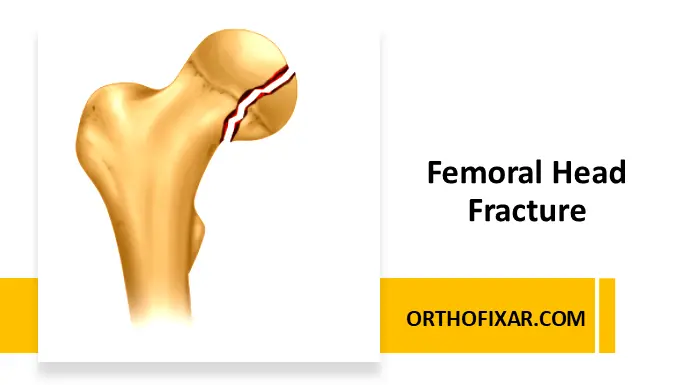 Femoral Head Fracture