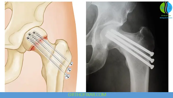 Femoral Neck Fracture screws fixation