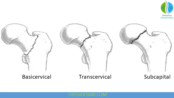 Femoral Neck Fractures Anatomic Classification