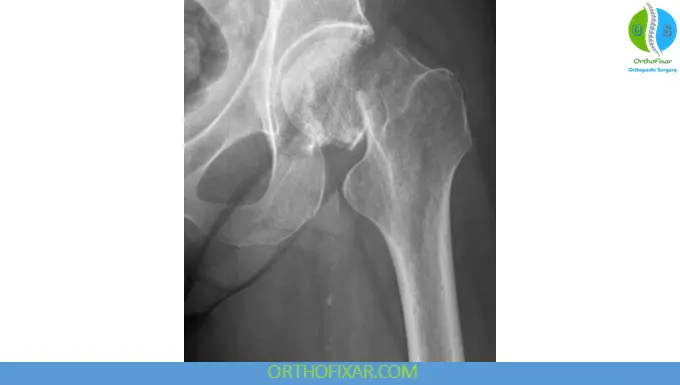 Femoral Neck Fractures xray