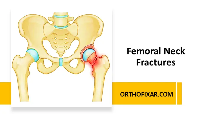 Femoral Neck Fractures