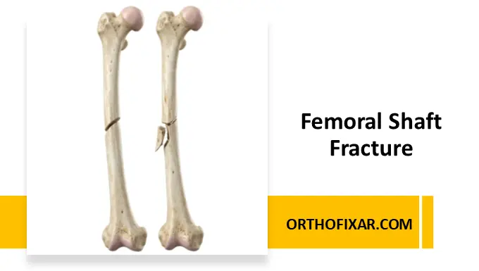 Femoral Shaft Fracture Causes, Diagnosis & Treatment
