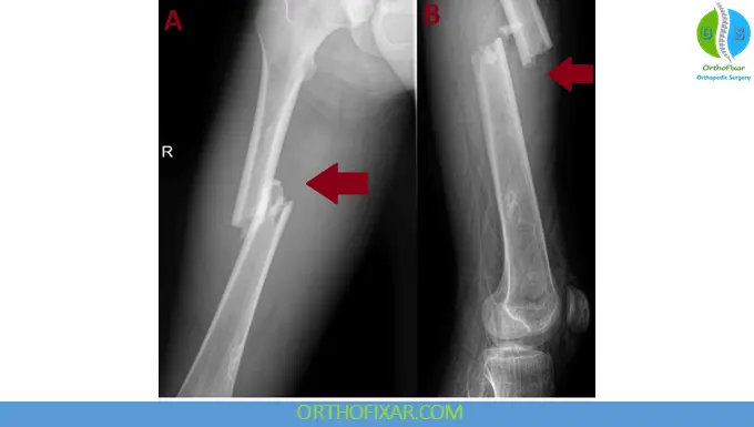 Femoral Shaft Fracture imaging