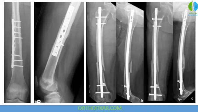 Femoral Shaft Fracture surgery treatment
