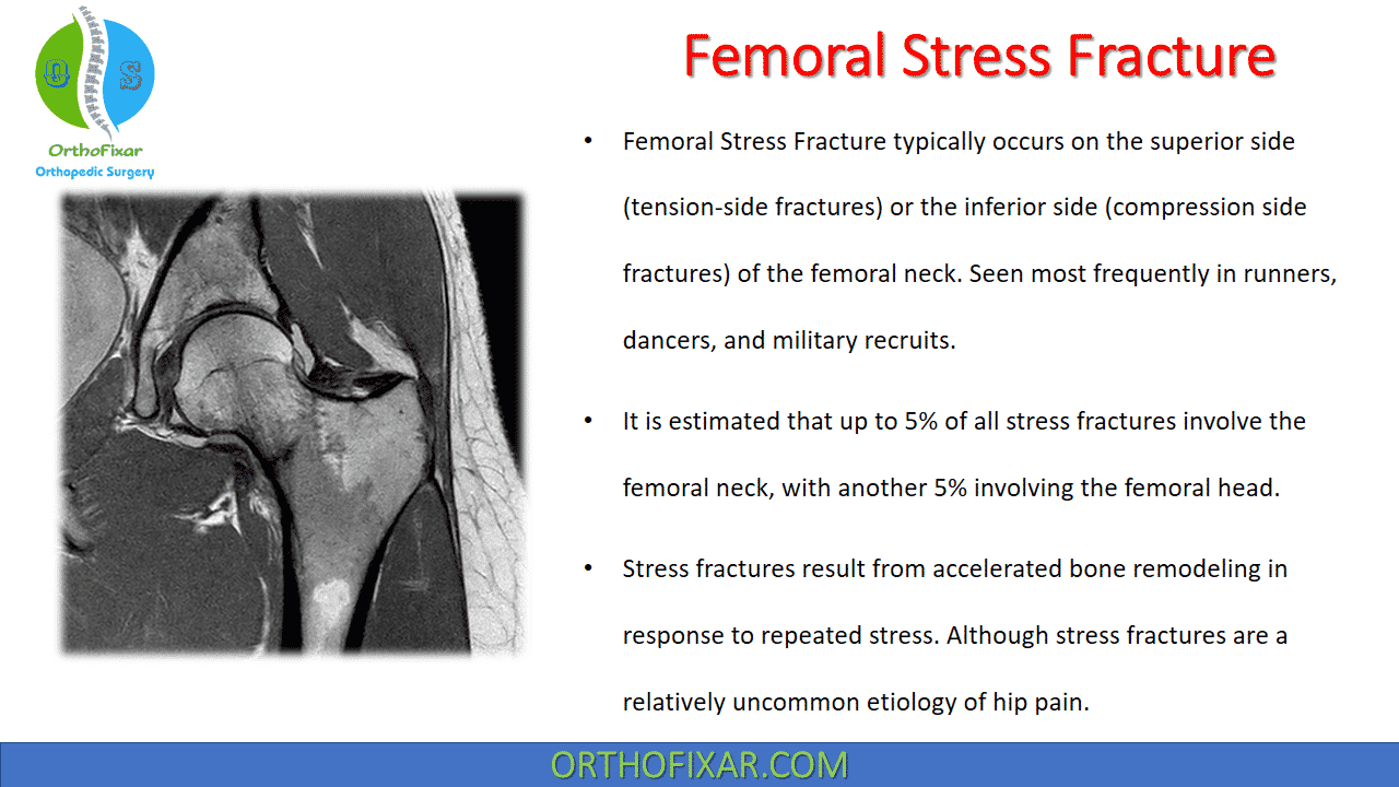 Femoral Stress Fracture 8570