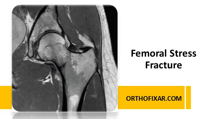 Femoral Stress Fracture