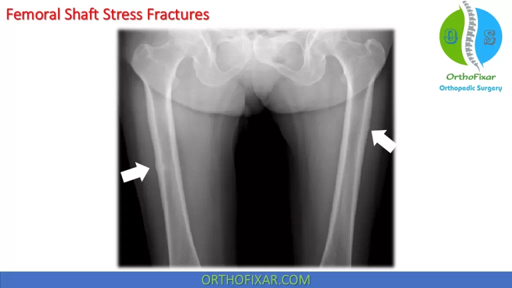 Femoral shaft stress Fracture