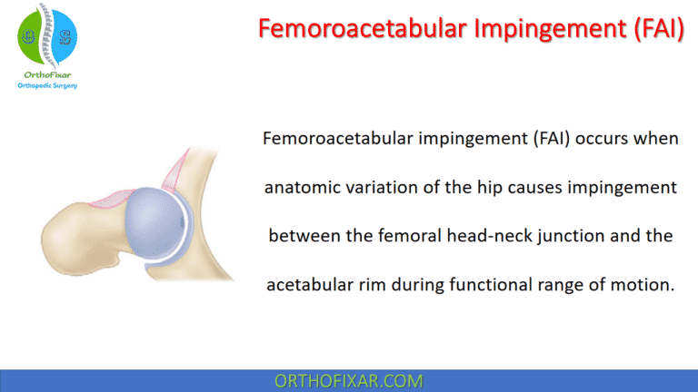 Femoroacetabular Impingement (FAI)