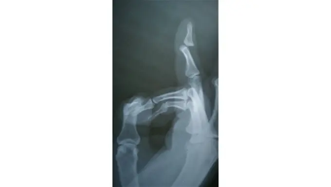 Finger Dislocation imaging