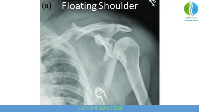 Floating Shoulder