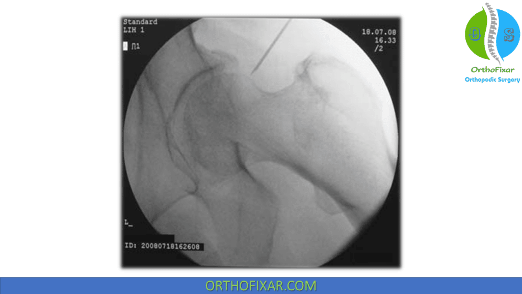 Fluoroscopic intra articular hip injection