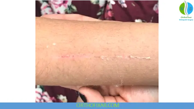 Fracture Casting: Principles, Techniques & Complications 9 Fracture Casting complication