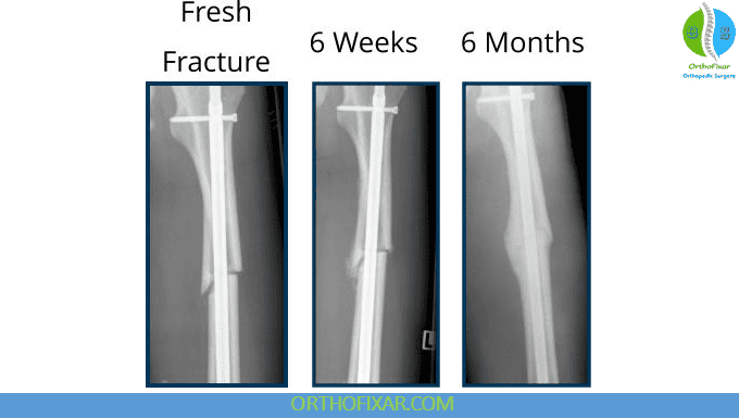 Fracture Healing