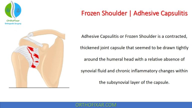 Frozen Shoulder