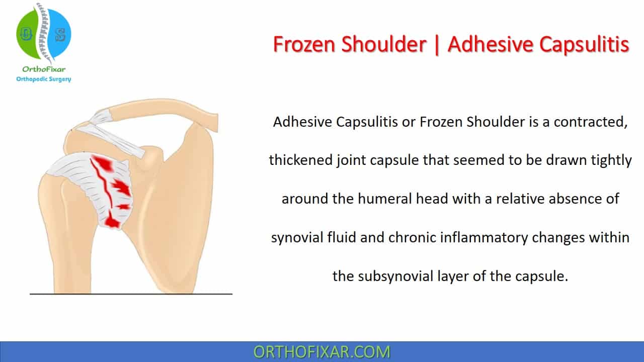  Frozen Shoulder | Adhesive Capsulitis 