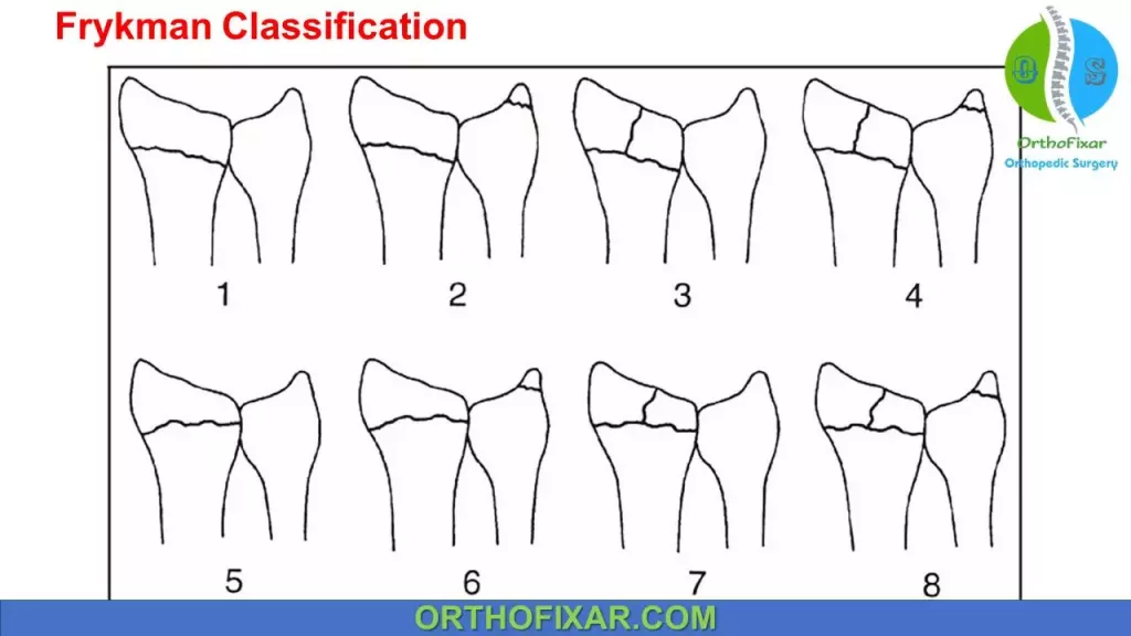 colles fracture classification