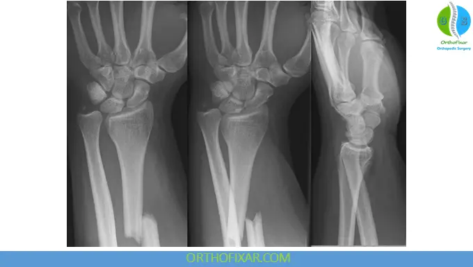Galeazzi Fracture xray